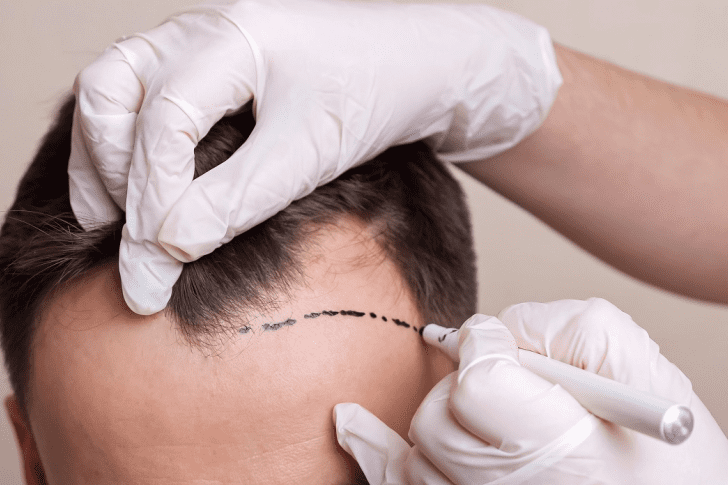 Guide to Hair Transplantation: Costs and Technological Advancements
