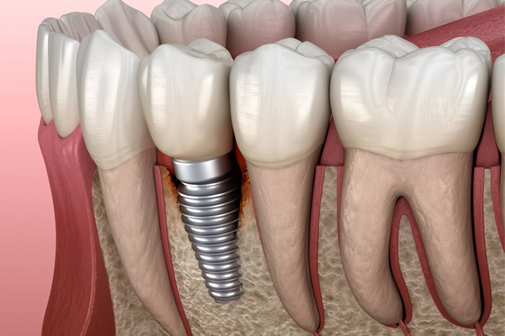 Guide to Dental Implants, Crowns, and Osseointegration