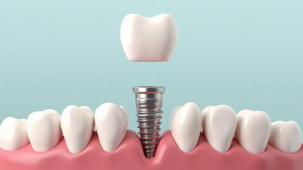 Costi Impianti Dentali: Guida Completa