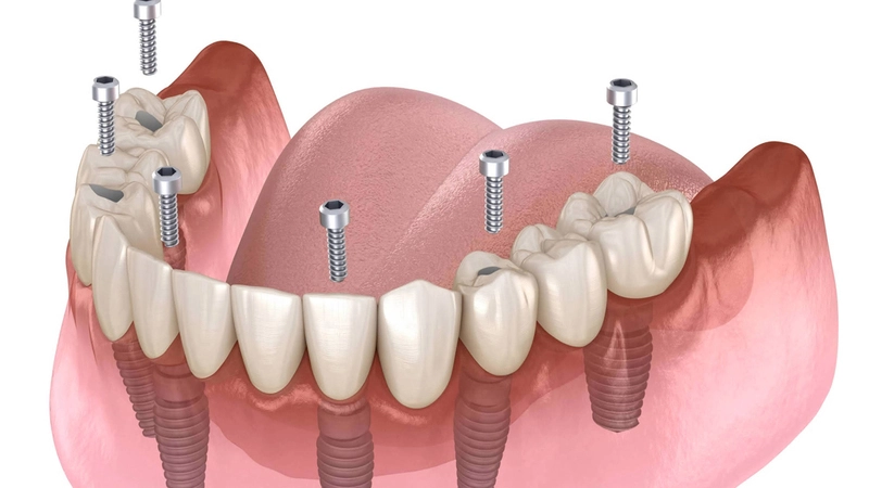 Affordable Dental Implants Options Near You